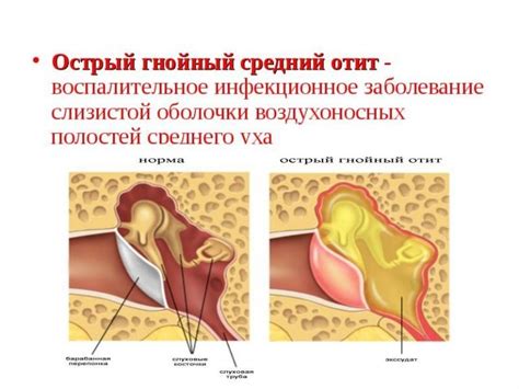 Отит у взрослых: причины и симптомы заболевания