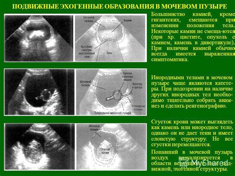 Ощущения, которые возникают при наличии 7-миллиметрового образования в мочевом аппарате