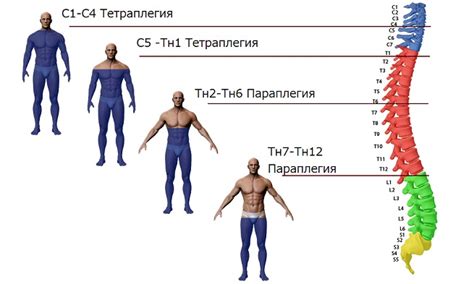 Параплегия: причины и симптомы