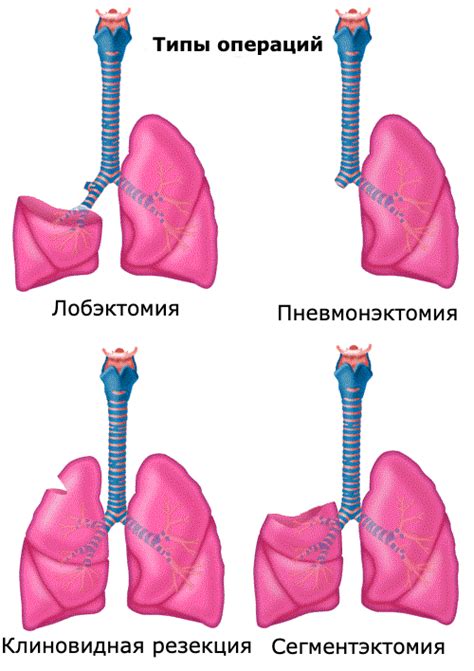 Патогенез отечности при раке легких: соотношение с онкологическим процессом