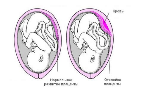 Патологии плаценты