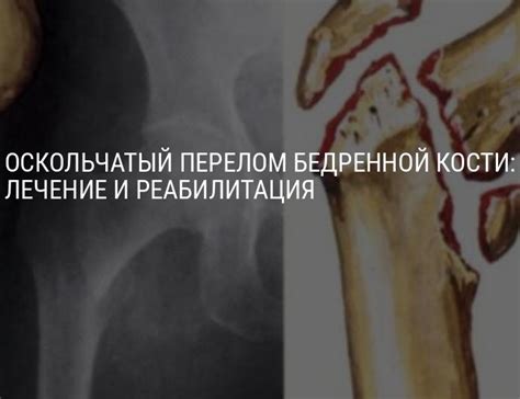 Период восстановления после повреждения индастриалом: факторы, которые необходимо учесть