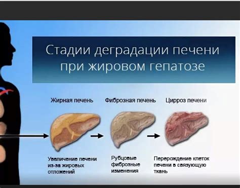 Питание при гепатозе стеатозе печени