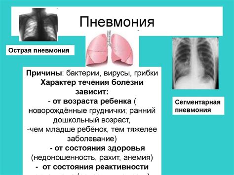 Пневмония: небезопасное заболевание органов дыхания