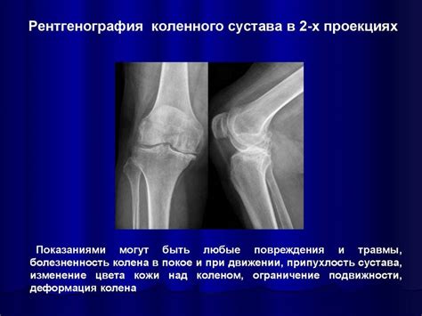 Подготовка к проведению рентгена коленного сустава в стоячей позиции: ключевые моменты