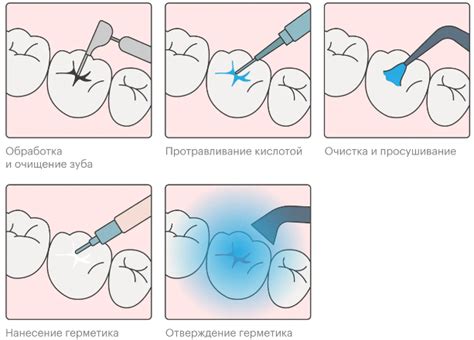 Подготовка к процедуре герметизации фиссур