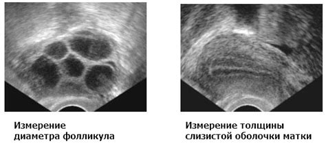 Поддержание и улучшение фертильности при ограниченности фолликулов в яичниках