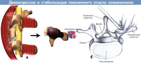 Поддержка и стабилизация позвоночника