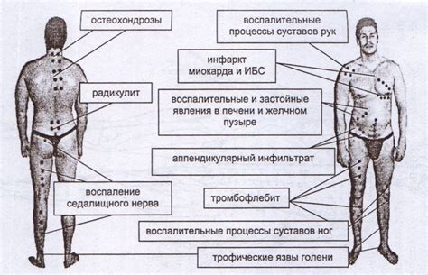 Показания для применения гирудотерапии