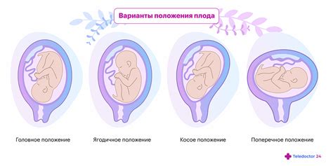 Положение плода в матке на 10 неделе беременности