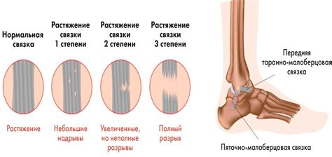 Понятие растяжения связок и эффекты использования низких температур