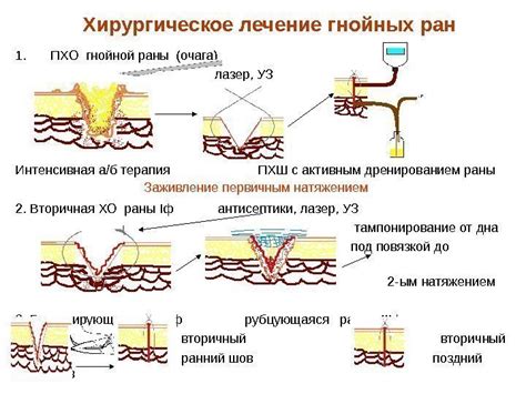 Последствия самостоятельного вскрытия гнойного очага