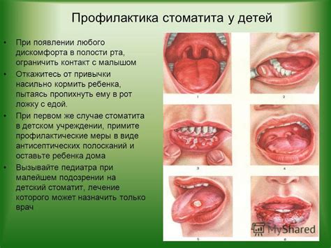 Последствия стоматита у ребенка: влияние на здоровье и развитие