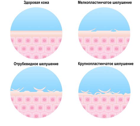 Появление шелушения на коже у малыша после купания во весьма горячей воде