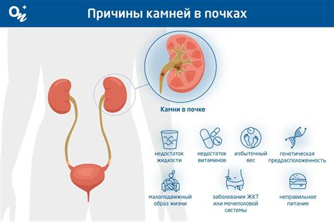 Правила применения тепловых процедур при образовании камней в почках