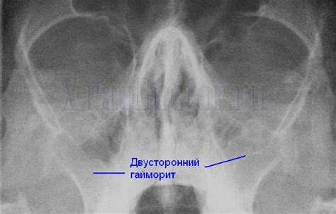 Правильное дыхание на рентгеновском снимке: почему оно важно?