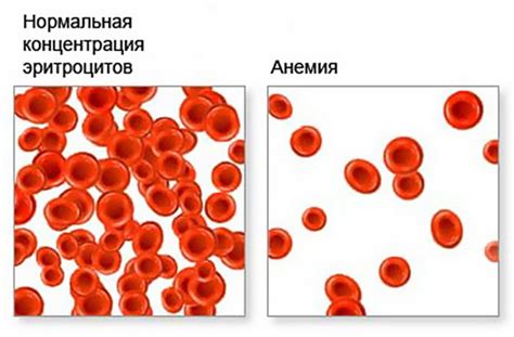 Предотвращение гипохромии: