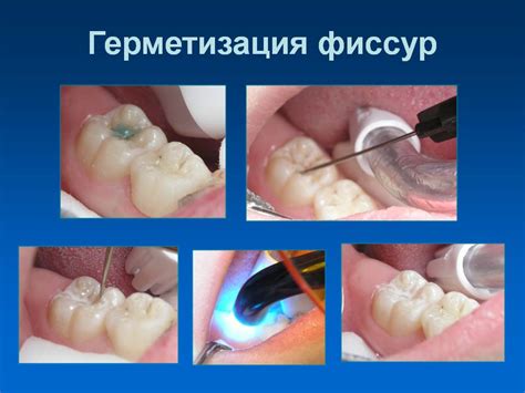 Преимущества герметизации фиссур