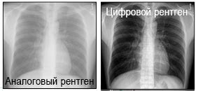 Преимущества использования рентгена для обследования легких