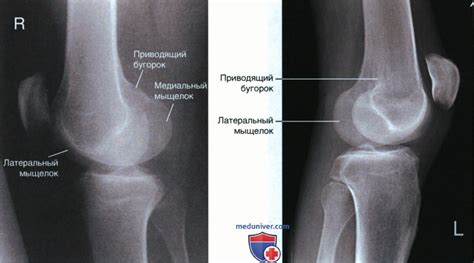 Преимущества рентгенографии коленного сустава в вертикальном положении