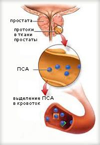 Применение Афалазы и Омника при аденоме простаты: сравнение эффективности