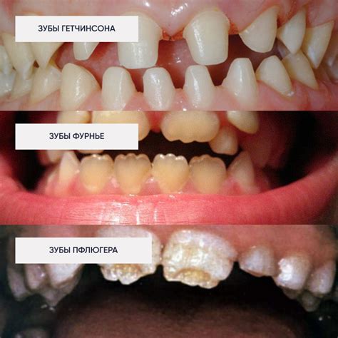 Причины возникновения гипоплазии зубной эмали
