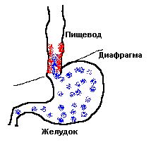 Причины возникновения эзофагита