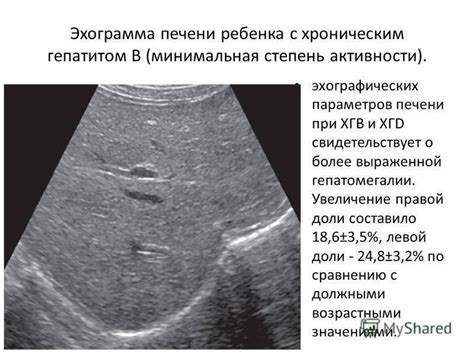 Причины гепатомегалии почек