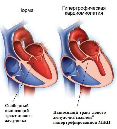 Причины гипокинезии миокарда левого желудочка: