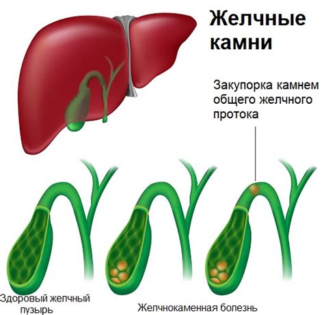 Причины гипоплазии желчного пузыря