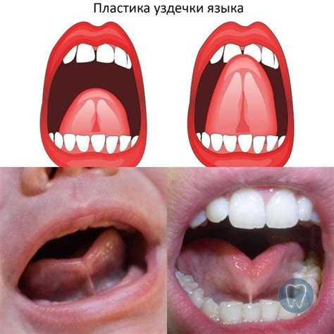 Проблема короткой уздечки у детей: что это такое?