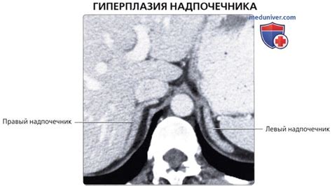 Прогнозы для пациентов с гиподенсивным образованием надпочечника