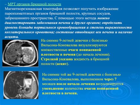 Прогнозы после лечения гипотензивных очагов в печени