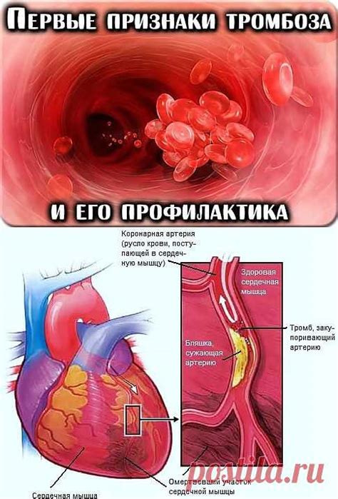 Прогрессирование тромбоза и его воздействие на состояние сосуда сердца