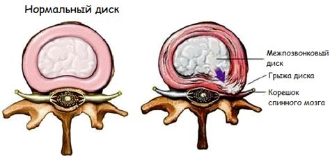 Происхождение грыжи спины и факторы, способствующие ее возникновению