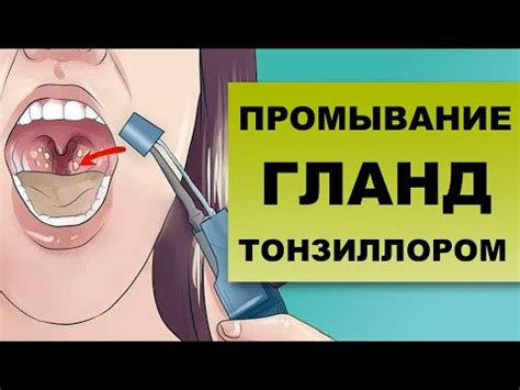 Промывание гланд без специальных инструментов