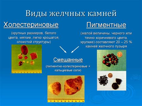 Противопоказания к применению средства при наличии камней в желчном пузыре