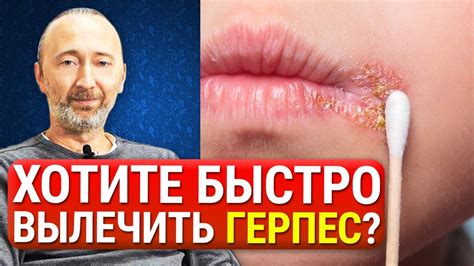 Профессиональные методы лечения герпеса на теле