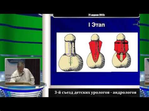 Профилактика гипоспадии головчатой формы