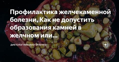 Профилактика желчекаменной болезни