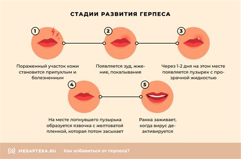 Процесс развития герпеса