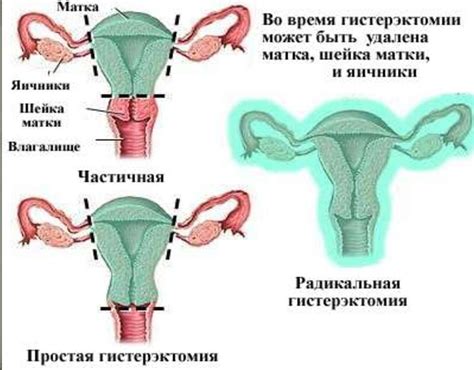 Психологические аспекты адаптации женщины после удаления матки