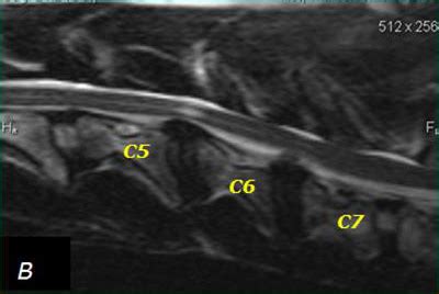 Разбиение позиционирования элементов позвоночного сегмента C5 C6
