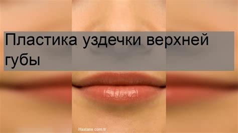 Распознавание неполноценной уздечки верхней губы: симптомы и признаки