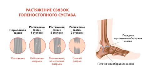 Распознавание повреждения связок: особенности и первоначальные признаки