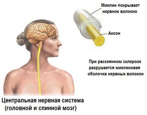 Рассеянный склероз: страхи и сомнения