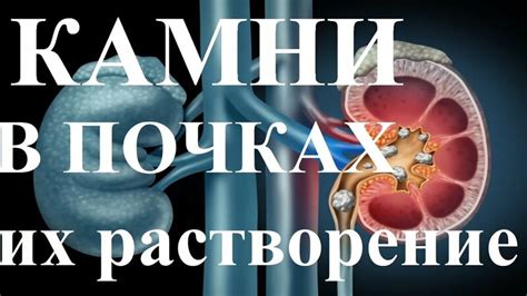 Растворение образований в почках и профилактика их повторения