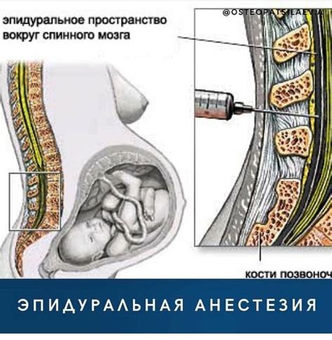 Риск нервных повреждений после эпидуральной анестезии: главные причины и факторы