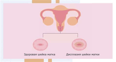 Роль вируса в окрестности шейки матки после родоразрешения