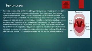 Роль температуры воды для горла при заболевании тонзиллитом